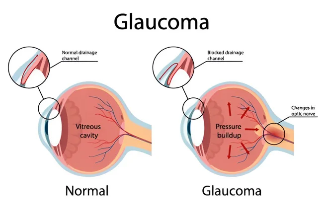 Glaucoma Test Price