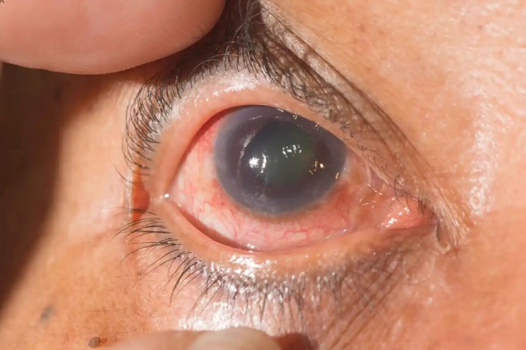 Best Glaucoma Specialist in Faridabad Near You – Book Your Consultation Today