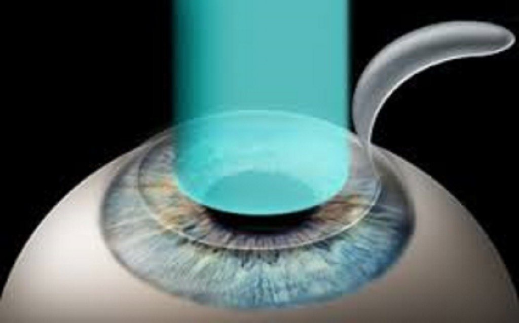 Refractive Surgery
